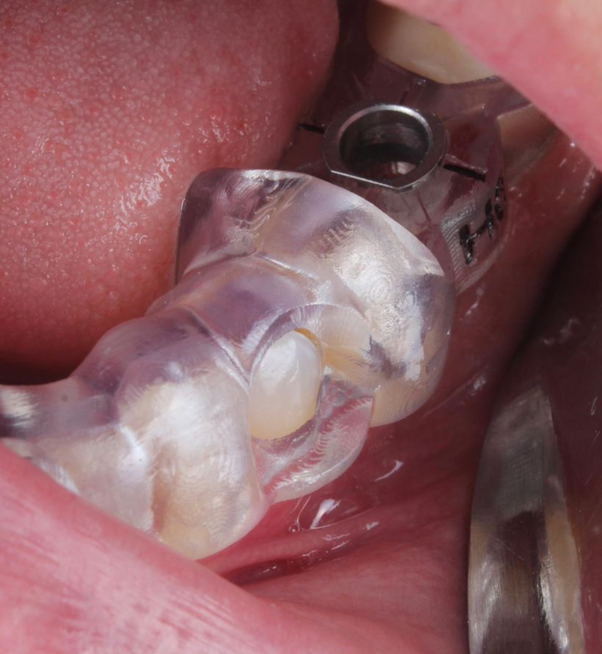 Cirurgia Guiada