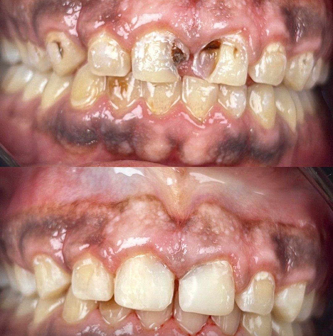Restauração Dentária