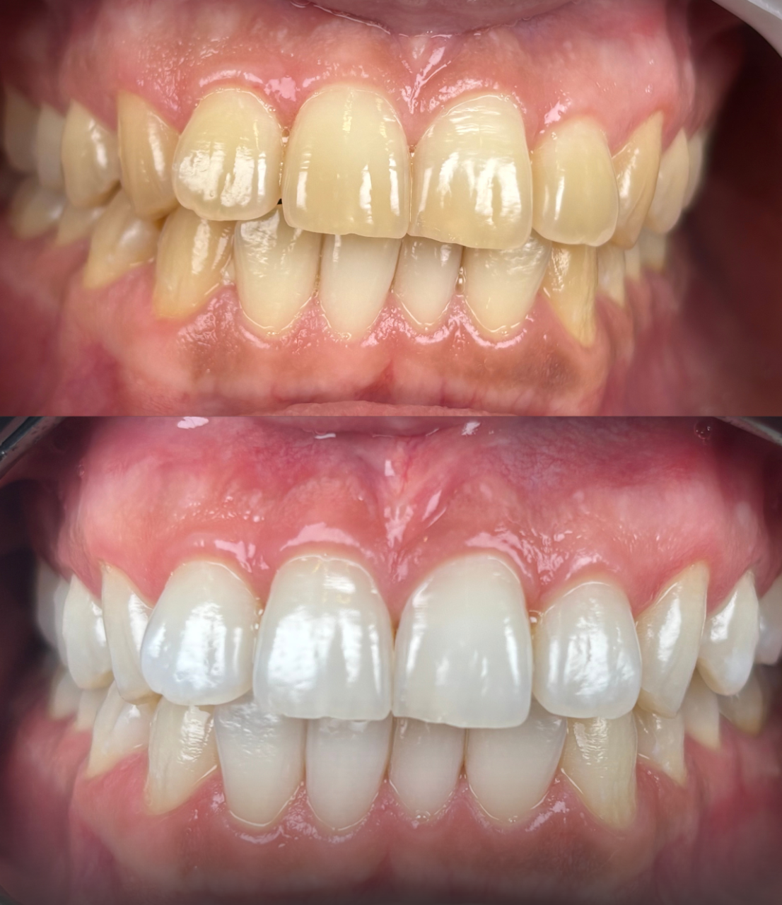 Clareamento Dental